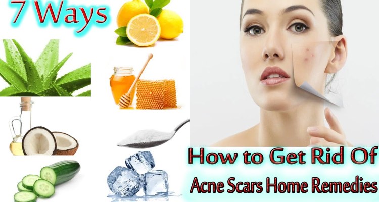 How To Get Rid Of Acne Scars At Home