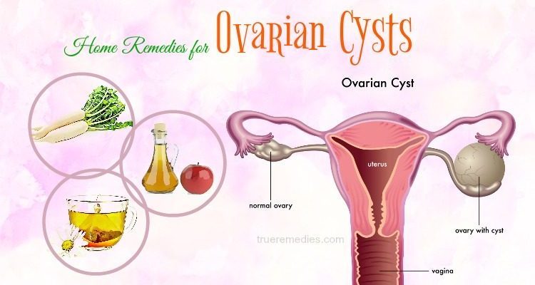 Different Types of Cysts on Ovaries